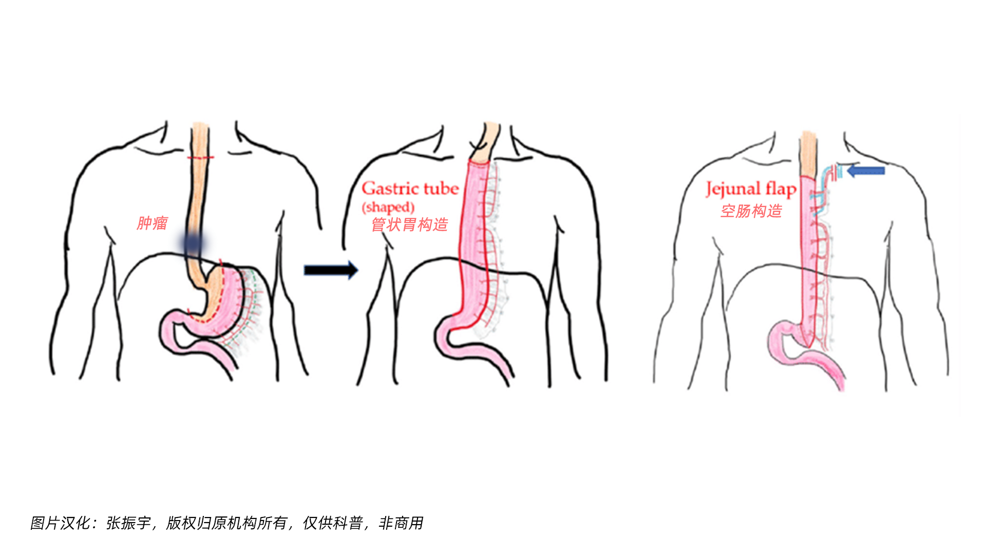 食道癌-2.png