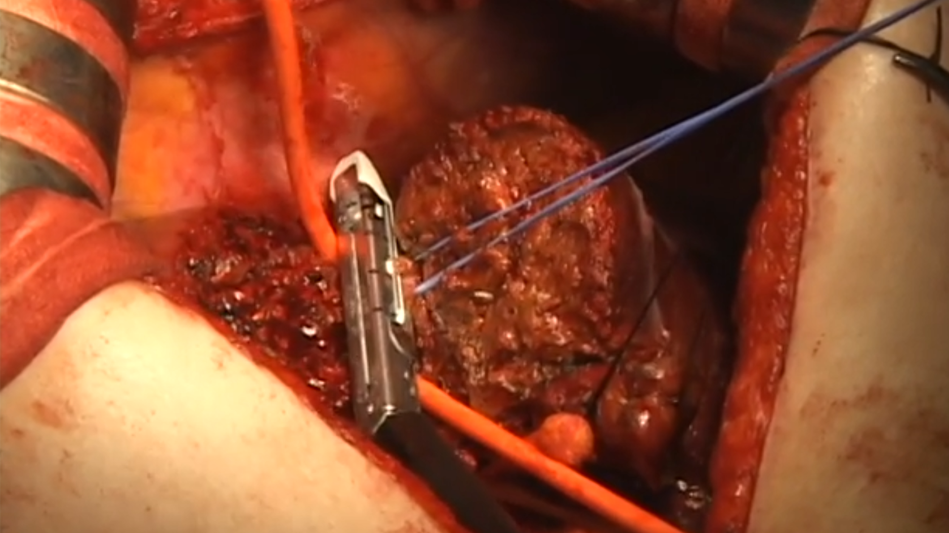 白钉断血管.png 白钉断血管.png