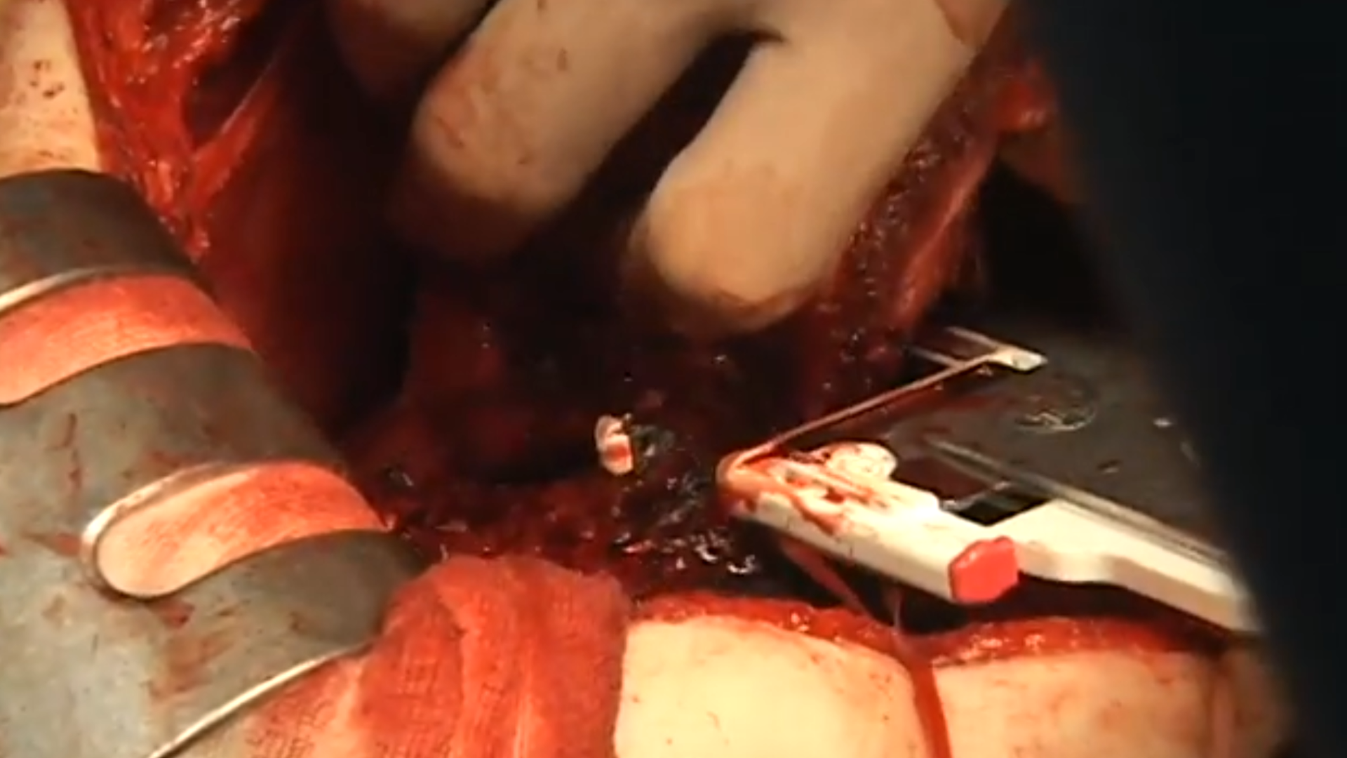 闭合器血管.png 闭合器血管.png